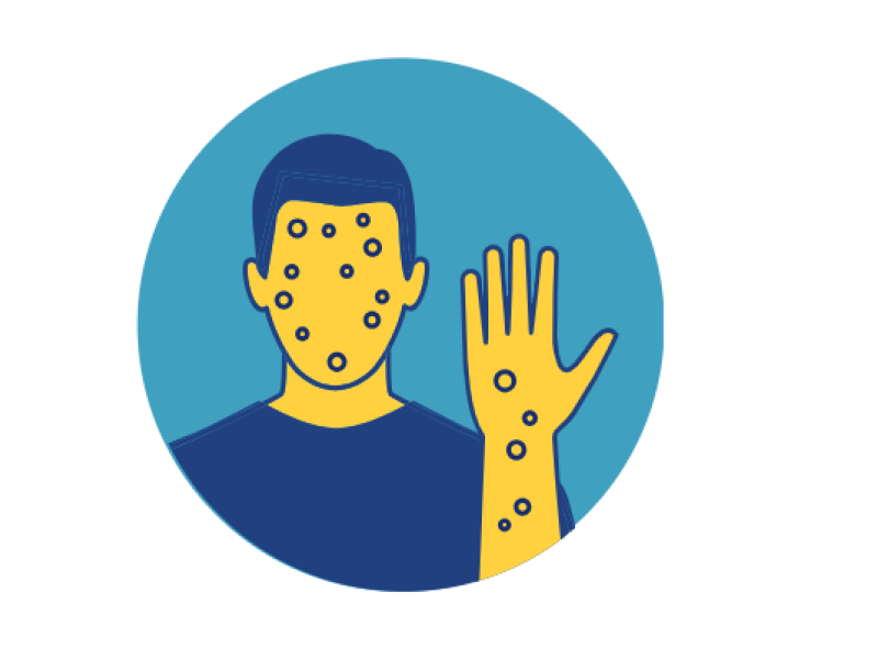 person with pox on face and hands